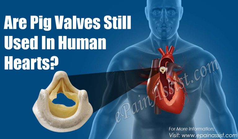 Are Pig Valves Still Used In Human Hearts?