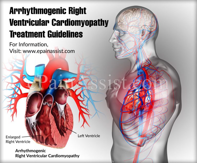 Arrhythmogenic Right Ventricular Cardiomyopathy Treatment Guidelines