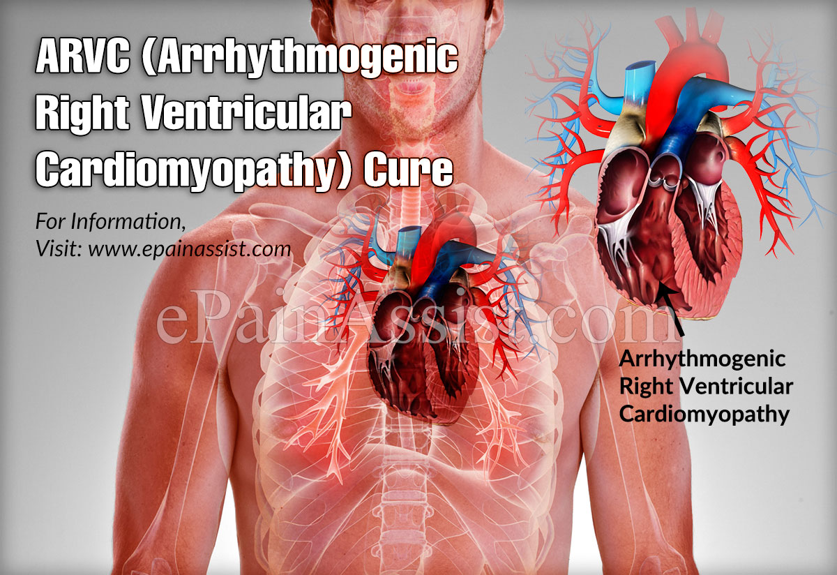 ARVC (Arrhythmogenic Right Ventricular Cardiomyopathy) Cure