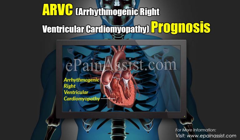 ARVC (Arrhythmogenic Right Ventricular Cardiomyopathy) Prognosis