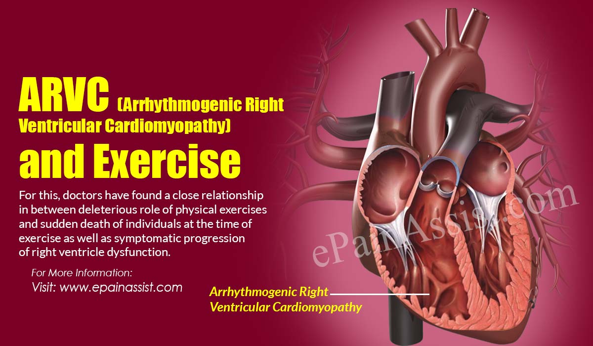 ARVC (Arrhythmogenic Right Ventricular Cardiomyopathy) and Exercise