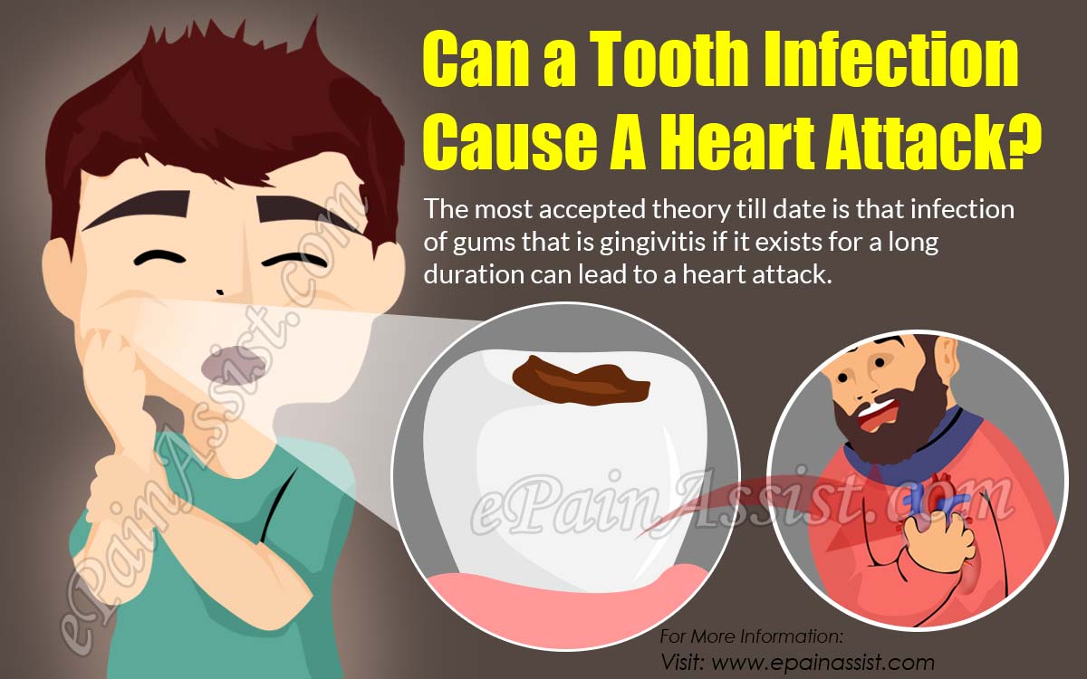 Can a Tooth Infection Cause A Heart Attack?