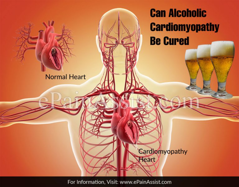 Can Alcoholic Cardiomyopathy Be Cured?