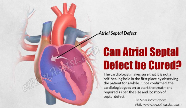 Can Atrial Septal Defect be Cured?
