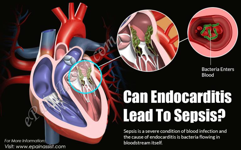 Can Endocarditis Lead To Sepsis?