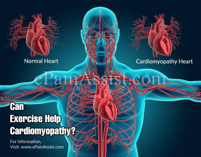 Can Exercise Help Cardiomyopathy?