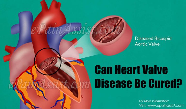 Can Heart Valve Disease Be Cured?