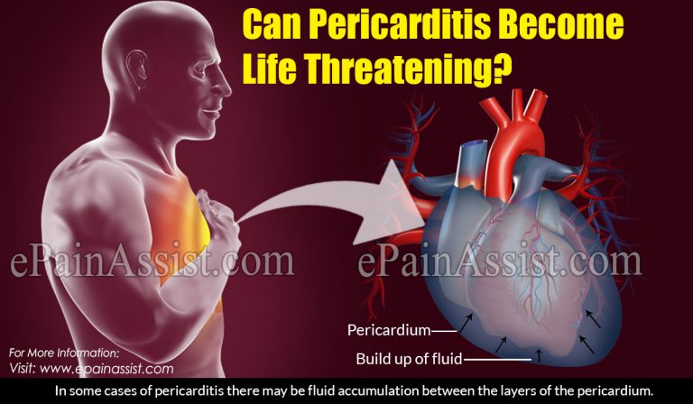 Can Pericarditis Become Life Threatening?