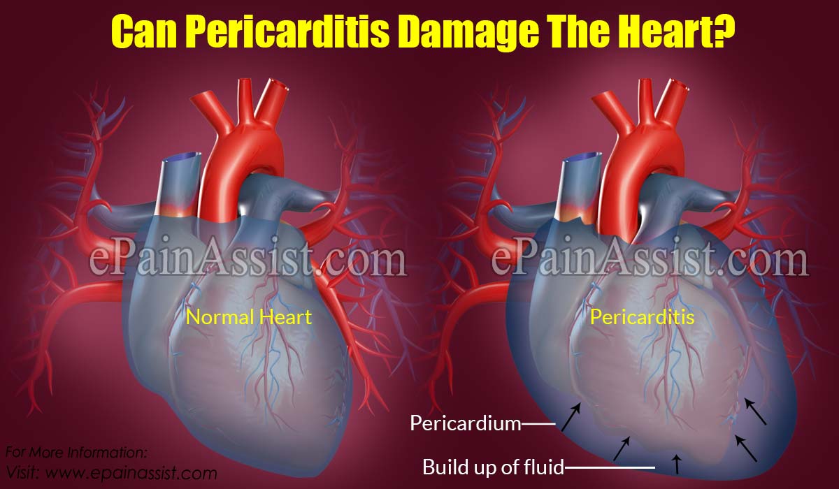 Can Pericarditis Damage The Heart?