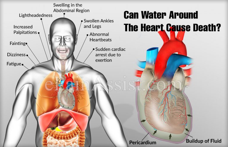 Can Water Around The Heart Cause Death?