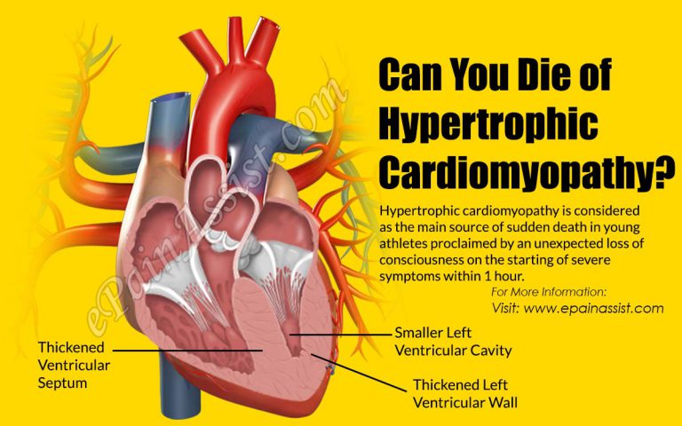 Can You Die of Hypertrophic Cardiomyopathy?