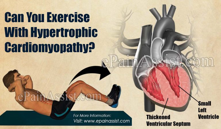 Can You Exercise With Hypertrophic Cardiomyopathy?