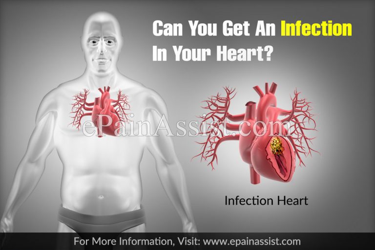 Can You Get An Infection In Your Heart?