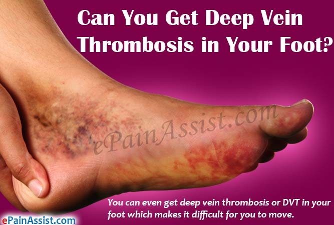 Can You Get Deep Vein Thrombosis in Your Foot?