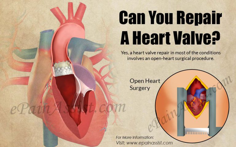 Can You Repair A Heart Valve?