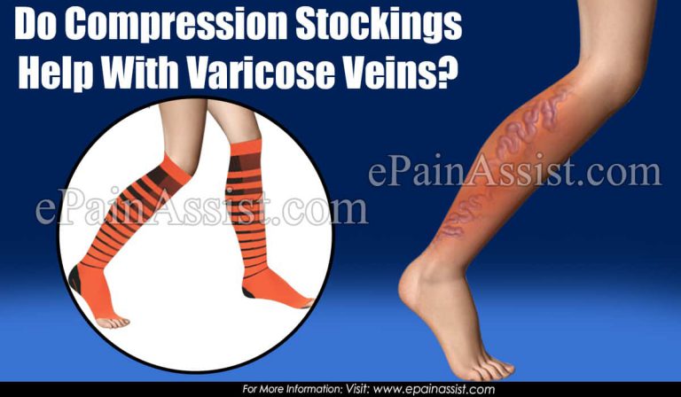 Do Compression Stockings Help With Varicose Veins?