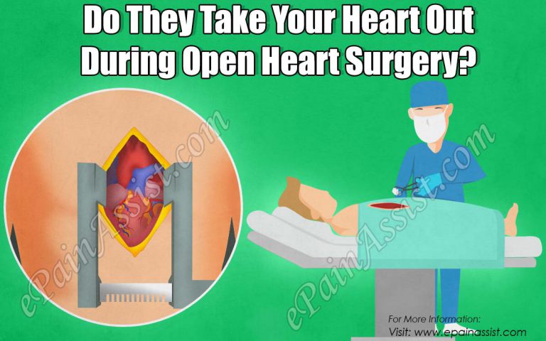 Do They Take Your Heart Out During Open Heart Surgery?