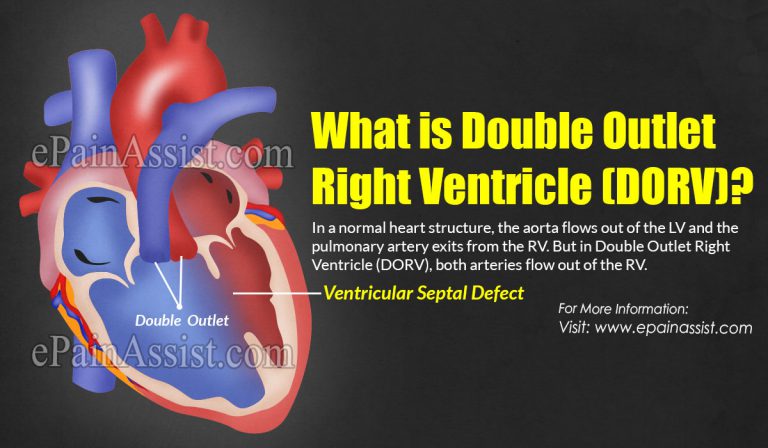 Double Outlet Right Ventricle (DORV): Causes, Symptoms, Treatment