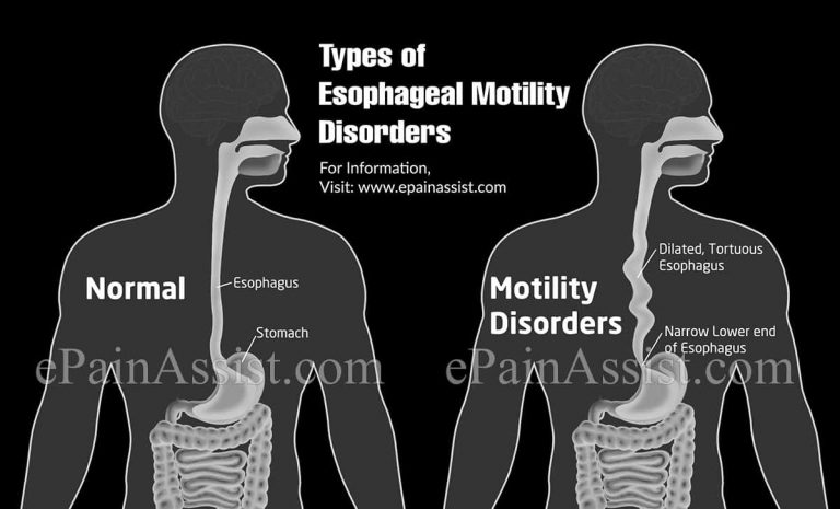 Esophageal Motility Disorders: Types, Symptoms, Treatment, Recovery, Risk Factors, Complications