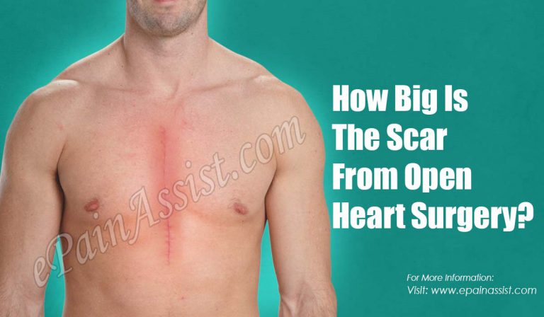How Big Is The Scar From Open Heart Surgery?