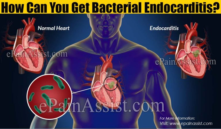 How Can You Get Bacterial Endocarditis?