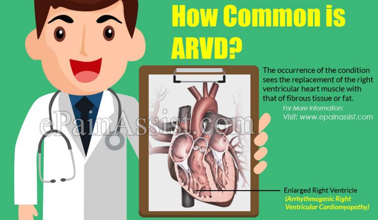 How Common is ARVD?