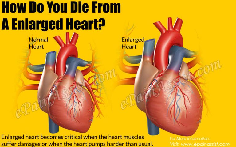 How Do You Die From An Enlarged Heart?