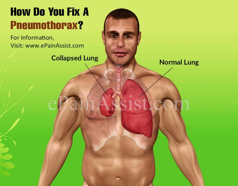 How Do You Fix A Pneumothorax?