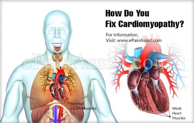How Do You Fix Cardiomyopathy?
