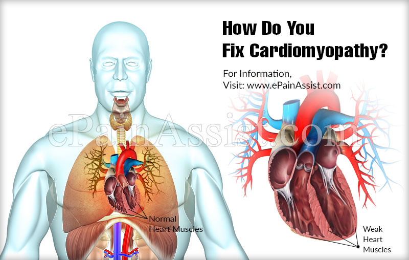 How Do You Fix Cardiomyopathy?