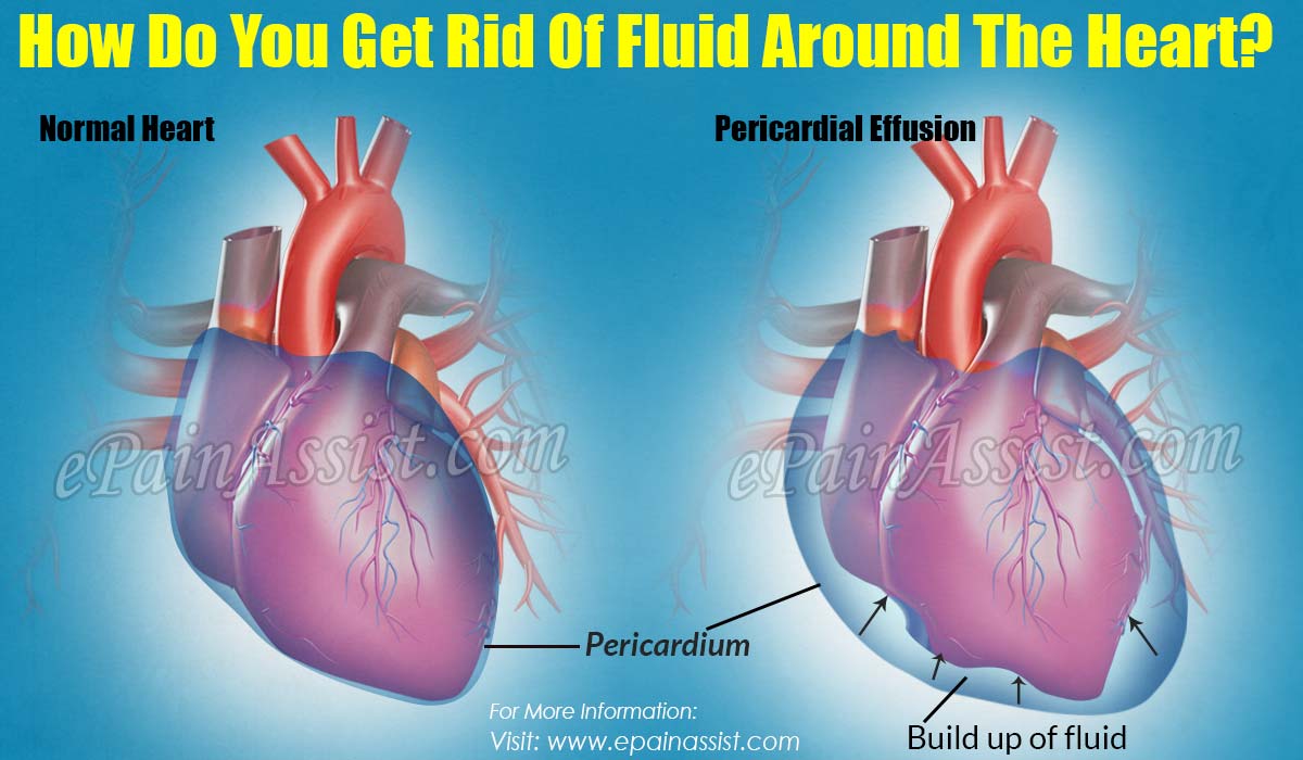 How Do You Get Rid Of Fluid Around The Heart?