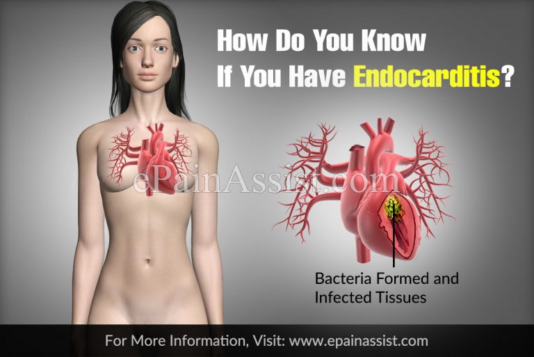 How Do You Know If You Have Endocarditis?