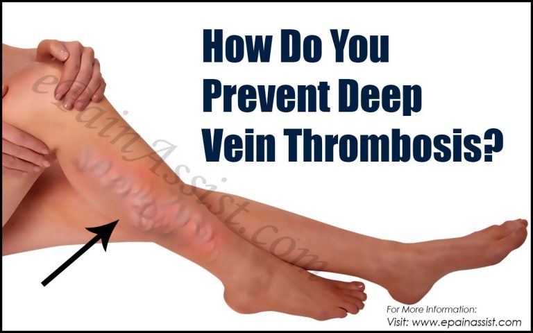 How Do You Prevent Deep Vein Thrombosis?