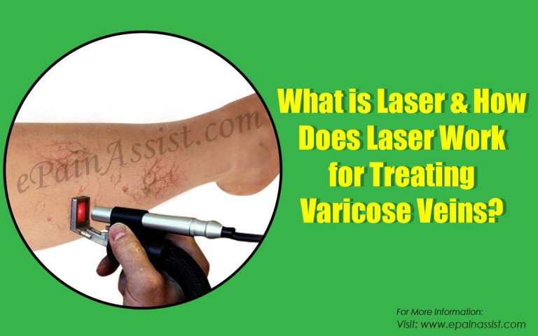 How Does Laser Work for Treating Varicose Veins, Know its Types, Effectiveness