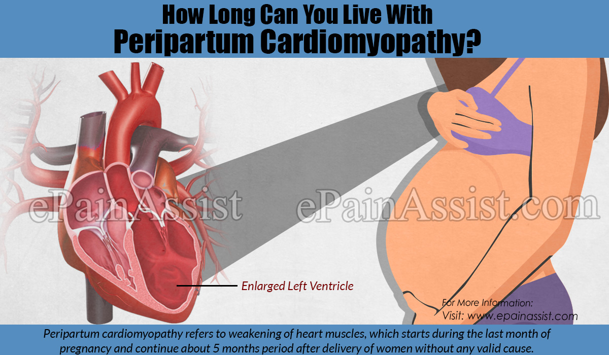 How Long Can You Live With Peripartum Cardiomyopathy?