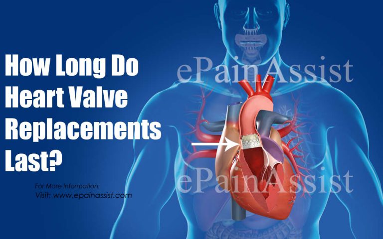 How Long Do Heart Valve Replacements Last?