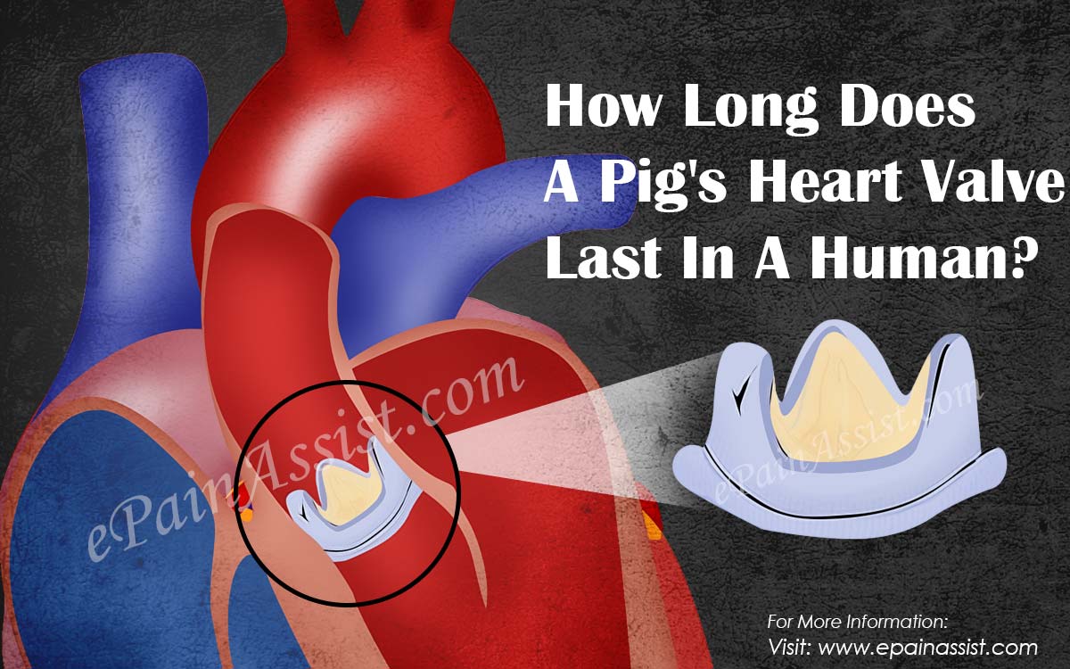 How Long Does A Pig's Heart Valve Last In A Human?