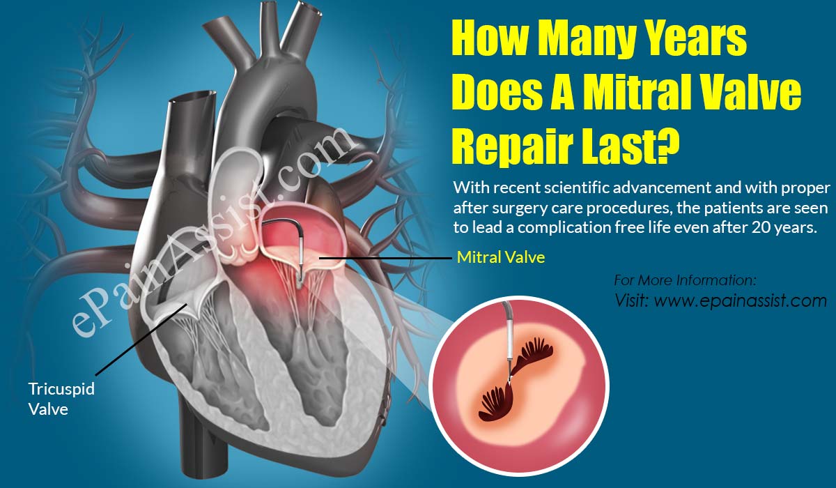 How Many Years Does A Mitral Valve Repair Last?