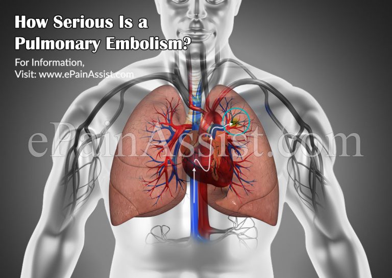 How Serious Is a Pulmonary Embolism?|Risk Factors, Treatment of Pulmonary Embolism