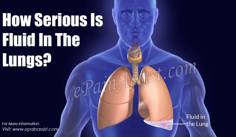 How Serious Is Fluid In The Lungs?