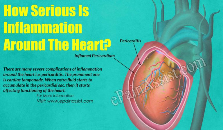 How Serious Is Inflammation Around The Heart?