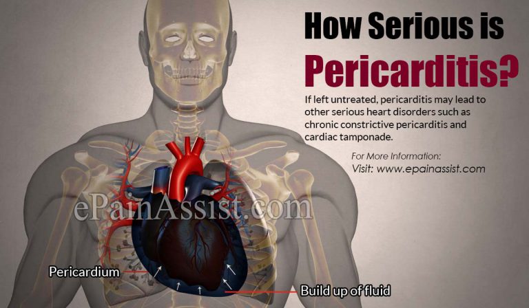 How Serious is Pericarditis?