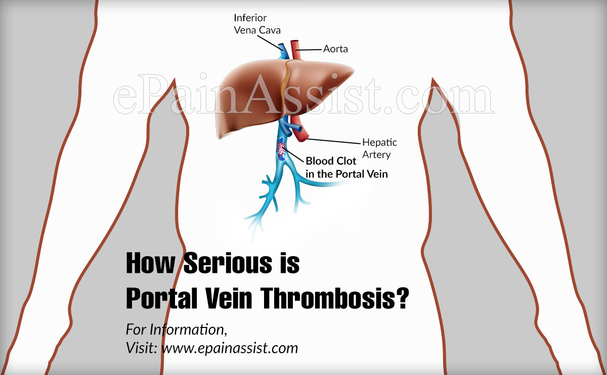 How Serious is Portal Vein Thrombosis?