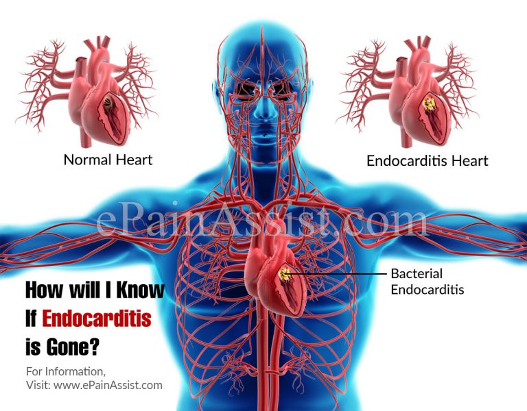 How will I Know If Endocarditis is Gone?