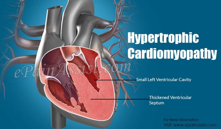 What Causes HCM (Hypertrophic Cardiomyopathy)?