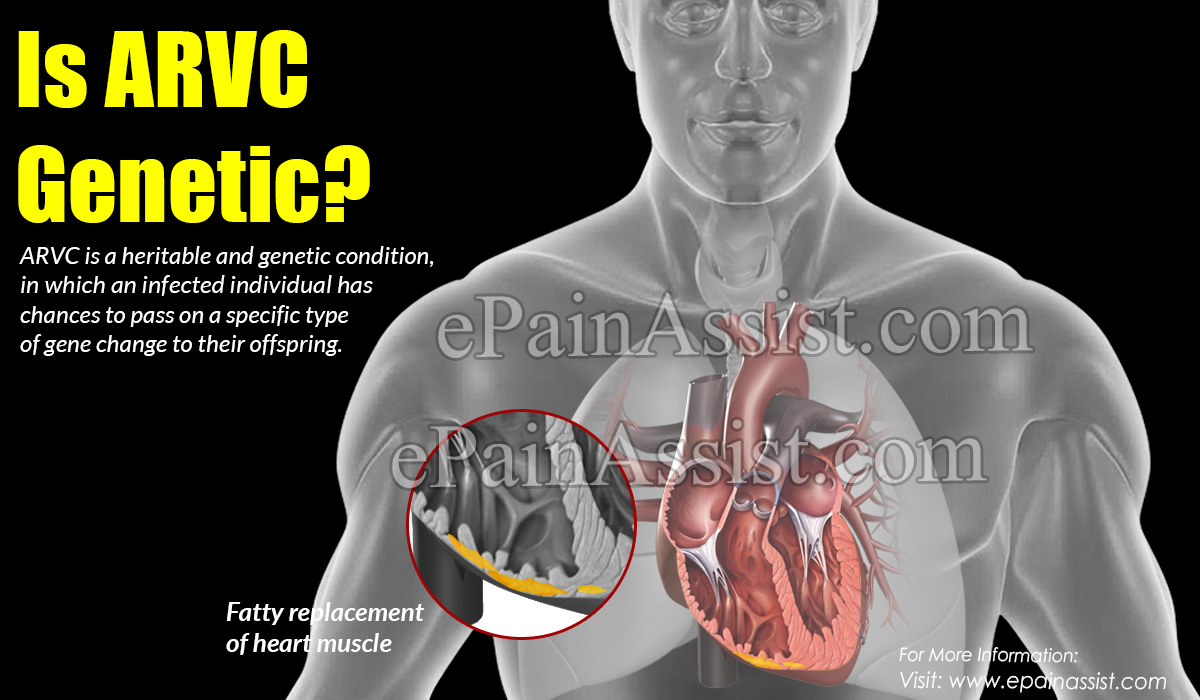 Is ARVC (Arrhythmogenic Right Ventricular Cardiomyopathy) Genetic?