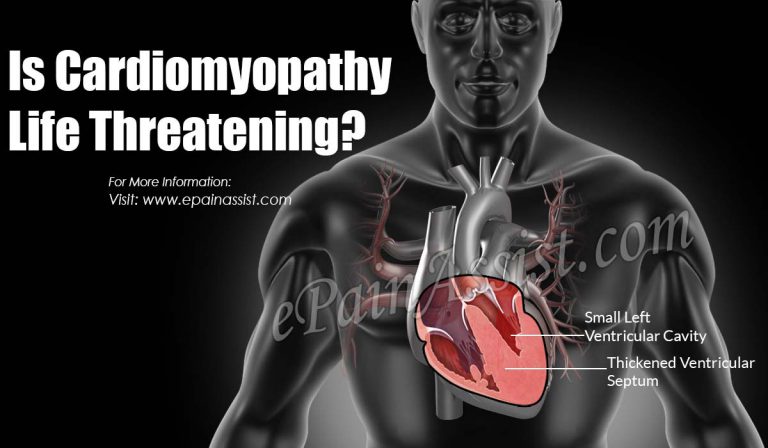 Is Cardiomyopathy Life Threatening?