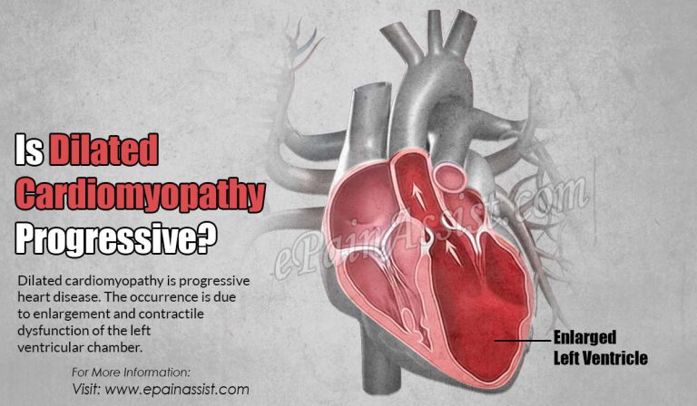 Is Dilated Cardiomyopathy Progressive?