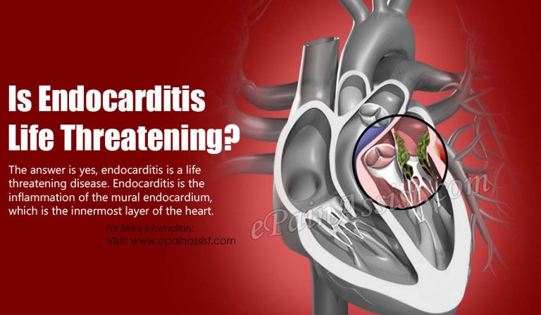 Is Endocarditis Life Threatening?