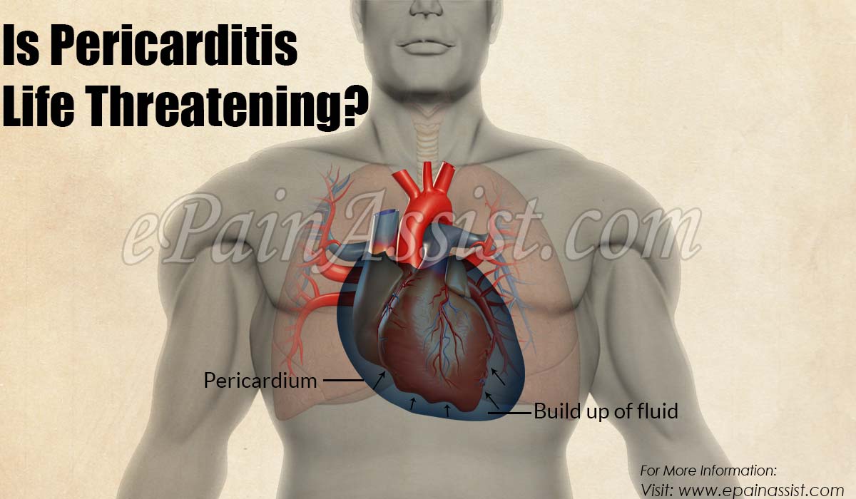 Is Pericarditis Life Threatening?